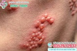 Mụn rộp sinh dục (Herpes): Dấu hiệu, hình ảnh và cách chữa