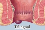 Dấu hiệu bệnh trĩ ngoại là gì? Cách chữa trĩ ngoại hiệu quả nhất