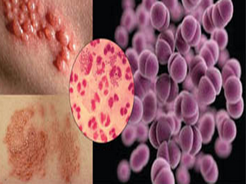 Dấu hiệu bệnh lậu ở nam giới: điều trị & phòng tránh