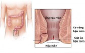 Nứt kẽ hậu môn có nguy hiểm không? Nguyên nhân, cách điều trị