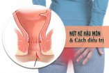Tổng hợp những cách chữa nứt kẽ hậu môn tại nhà hiệu quả
