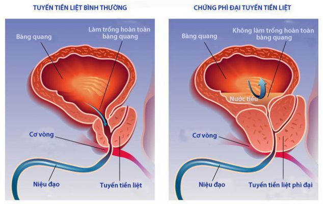 Phì đại tuyến tiền liệt: Nguyên nhân, cách điều trị, phòng tránh 