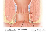 Bệnh rò hậu môn: Nguyên nhân, dấu hiệu và cách điều trị