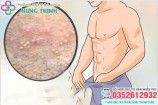 Thân dương vật nổi mụn trắng, mụn đỏ gây ngứa là bệnh gì? Cách chữa