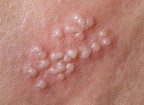 Thân dương vật nổi mụn gây ngứa màu đỏ, trắng là bệnh gì?