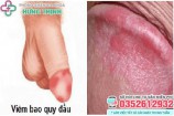 Viêm bao quy đầu: Hình ảnh, triệu chứng, cách chữa