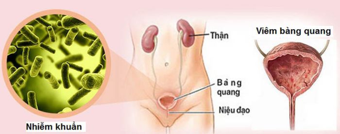 Viêm bàng quang: Nguyên nhân, triệu chứng và cách điều trị