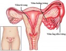 Viêm buồng trứng: Nguyên nhân, dấu hiệu và cách điều trị