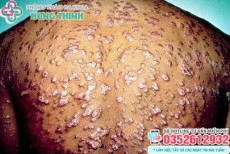 10 Cách chữa bệnh giang mai ở nam, nữ giới tại nhà hiệu quả