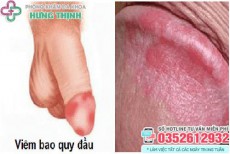 Viêm bao quy đầu: Hình ảnh, triệu chứng, cách chữa