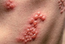Các dấu hiệu nhận biết mụn rộp sinh dục (Herpes sinh dục)
