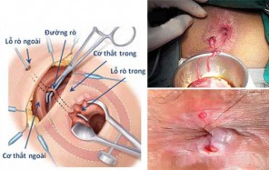 Cách trị rò hậu môn tại nhà an toàn, hiệu quả nhất