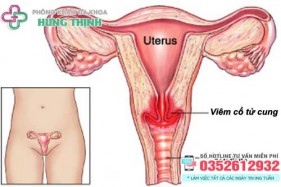 10 Cách chữa viêm cổ tử cung tại nhà hiệu quả ở phụ nữ
