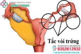 10 Cách chữa tắc vòi trứng tại nhà hiệu quả, chữa ở đâu tốt