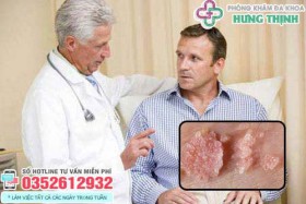 Cách chữa bệnh sùi mào gà