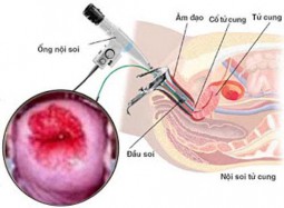 Đốt viêm lộ tuyến cổ tử cung bao nhiêu tiền?