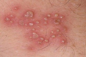 Các giai đoạn phát triển của mụn rộp sinh dục & triệu chứng