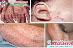 12 Địa chỉ xét nghiệm khám chữa bệnh giang mai ở đâu tốt Hà Nội