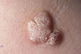 Mụn cóc sinh dục có phải sùi mào gà? Cách phân biệt