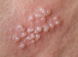 Thân dương vật nổi mụn gây ngứa màu đỏ, trắng là bệnh gì?