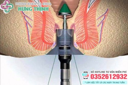 Chi phí cắt trĩ hết bao nhiêu tiền? Bảng giá chữa bệnh trĩ 2026