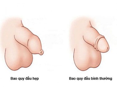 Top 7 địa chỉ cắt, chữa hẹp bao quy đầu ở đâu tốt tại Hà Nội
