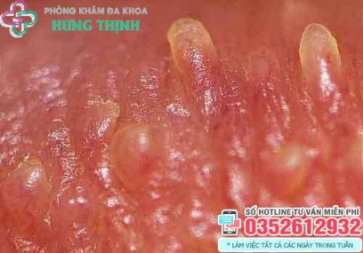 Gai sinh dục là gì? Thường mọc ở đâu? Có nguy hiểm không?