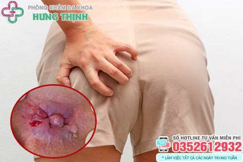 10 Cách làm co búi trĩ ngoại tại nhà làm teo xẹp búi trĩ nhanh nhất