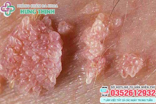 Chi phí chữa bệnh sùi mào gà hết bao nhiêu tiền
