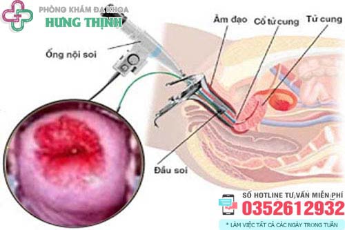 Chi phí đốt viêm lộ tuyến cổ tử cung giá bao nhiêu tiền 2026