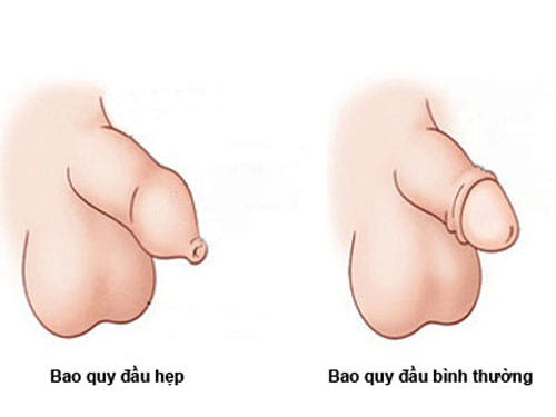 Top 7 địa chỉ cắt, chữa hẹp bao quy đầu ở đâu tốt tại Hà Nội