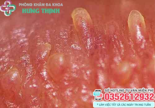 Gai sinh dục là gì? Thường mọc ở đâu? Có nguy hiểm không?