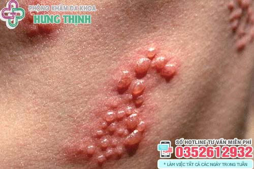 Mụn rộp sinh dục (Herpes): Dấu hiệu, hình ảnh và cách chữa